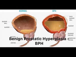 Prostate Problems: Why They Happen & How to Fix Them