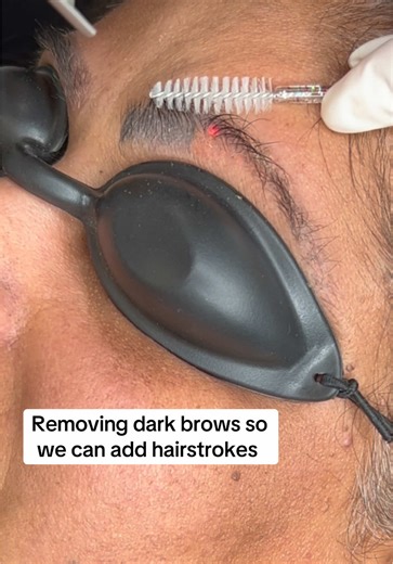 Effective Laser Tattoo Removal for Dark Blue Brows