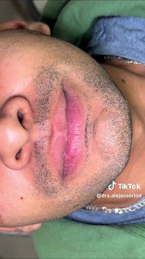 #ackerdental #protesisflexible #odontologiasuba #periodoncia 📲3108662658 🦷💓