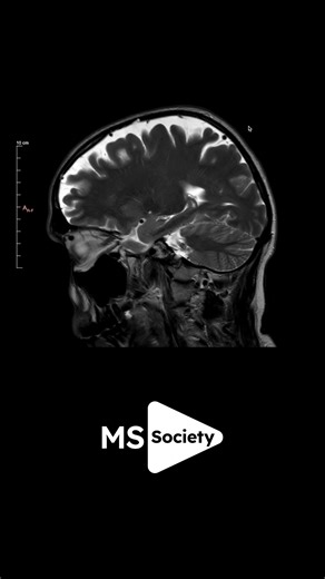 MS Society on Instagram: "🧠 MRI scans play an important role in multiple sclerosis. They help doctors understand what’s happening in your brain and spinal cord. And they help researchers get closer to better treatments. From diagnosis to tracking change over time, MRI scans play a big part in MS research and care. Tap the link in bio to learn 7 things you need to know about MRI scans and MS! #MsSociety #MSResearch"