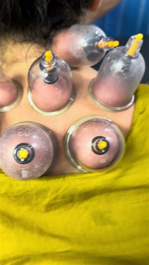 Severe Neck & Upper Back Pain? Try Cupping Therapy 🔥 Real Treatment Session