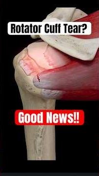 Rotator Cuff Tear On MRI? Here’s Why It Might NOT Be Causing Your Pain #shoulderpain #rotatorcuff