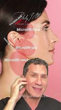 Microlift vs Endoscopic facelift! What are the differences?