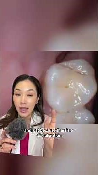How to tell if you have a cavity. #cavity #cavities #dentist #selfexam