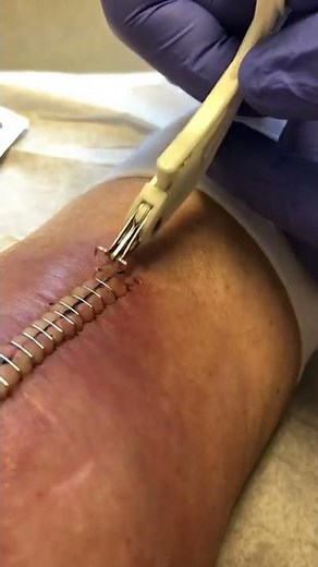 Staple Removal, Jan’s left knee replacement.