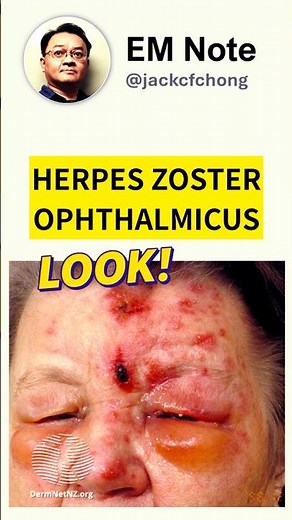 Herpes Zoster Ophthalmicus (HZO)