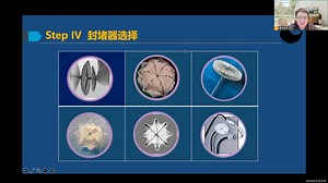 心腔内超声引导下PFO介入封堵治疗