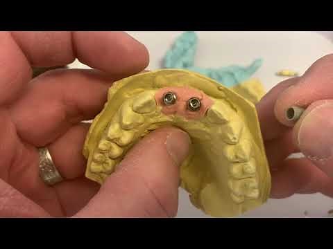 CEREC TiBase Dental Implant Crowns 8 and 9 - Whole Process!