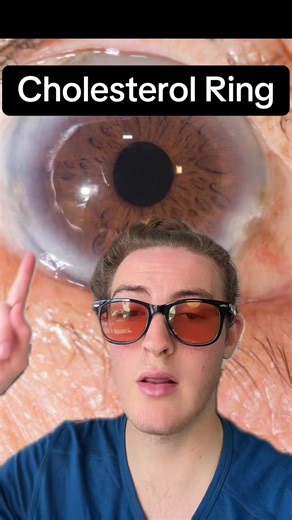 Understanding Cholesterol Rings in Iridology