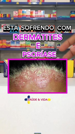 Propionato de Clobetasol: Tratamento para Dermatites e Psoríase
