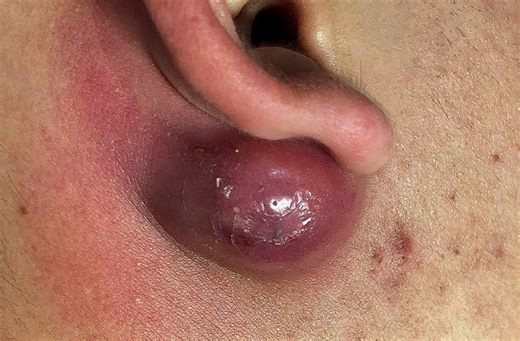 Infected Large Cyst Behind Ear Drained