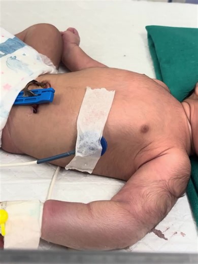 Newborn Baby Having Seizures in the NICU Critica | newborn baby