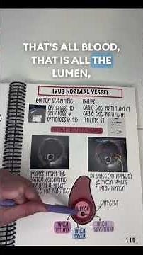 Can you explain a normal IVUS image? Need more? Find it in The Coronary Intervention Visual Manual