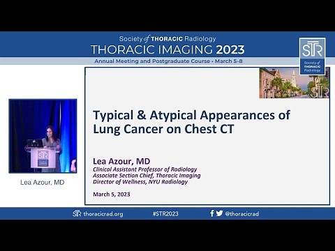 Typical and Atypical Appearances of Lung Cancer on Chest CT