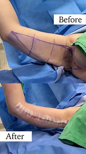 Arm Lift Transformation