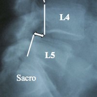 Estenosis lumbar y listesis L4-L5 - Unidad de Neurocirugía RGS