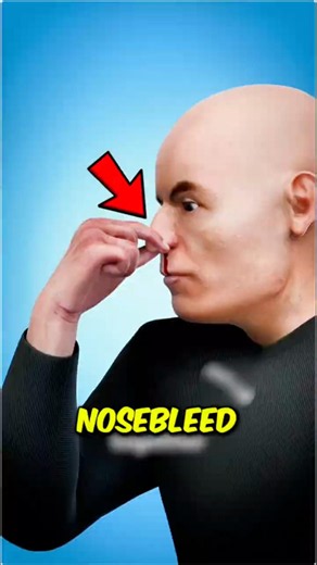 STOP Tilting Your Head! Here's What to Actually Do for a Nosebleed...