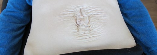 Diastasis Rectus Abdominis - Diane Lee & Associates Physiotherapy