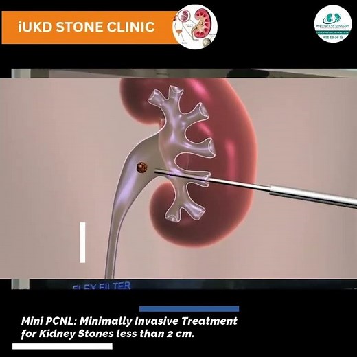 Mini PCNL II key hole technique to remove kidney stones