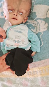 Approach to Large Head ( Hydrocephalus) !!! Practical demonstration on a patient #largehead #macrocephaly #hydrocephalus #FCPS #MCPS #md #mbbs | Dr. Arshad Mehmood - Child Specialist