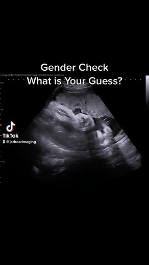 Gender Check. What is your guess? #jerbearimaging #genderreveal #boyorgirl? #girlorboy? #guess #whatisitchallenge #fyp #athomesonogram #ultrasound #baby #ultrasound #canyouseeit www.jerbearimaging.com | JerBear Imaging