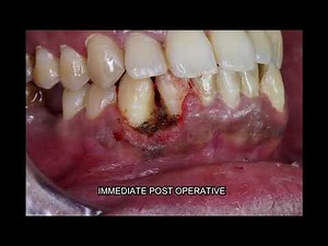 Oral Pyogenic Granuloma Treatment in Bangalore - Dental Solutions Bangalore