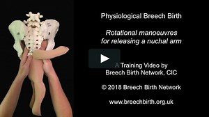 Nuchal Arm Release - Rotational Manoeuvre