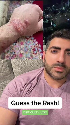 Guess the rash! #rash #dermatology #mystery #medschool #skincare #guess