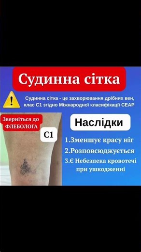 Vascular meshwork Destroys the beauty of the legs! What to do? #health #medicine