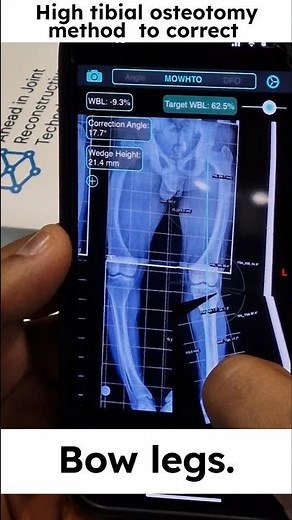 Bow leg Deformative correction by( HTO) #bowlegs