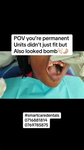 Replacing Missing Anterior Teeth with Permanent Units