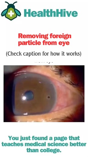 HealthHive on Instagram: "Removing a Foreign Particle from the Eye: A Step-by-Step First Aid Guide 👁️✨ Getting something stuck in your eye—like an eyelash, dust, or sand—is a common and often painful experience. Here’s the safest way to handle it and when to stop and seek immediate medical help. Safe, At-Home Steps to Try First: 1. Wash Your Hands Thoroughly: Before touching anywhere near your eye, ensure your hands are clean to prevent introducing bacteria. 2. Blink Repeatedly: Rapid blinking 