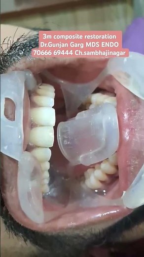 3M Composite Restoration for Front Teeth#DentalRestoration #3MComposite #composite #dentist #dental