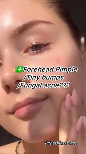 FOREHEAD PIMPLES?🤯Tiny Bumps, Fungal Acne & Breakouts—Here’s the FIX!✨#SkincareHacks #glowuptips