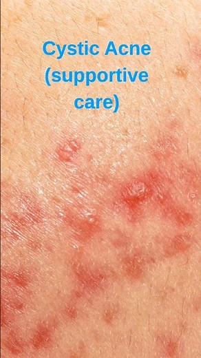Cystic Acne? Stop Making This Mistake! 😱