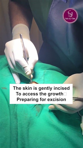 Painless Skin Growth (Neurofibroma) Removal by Dr. Dattatreya Hazra | Skin Joy Clinic