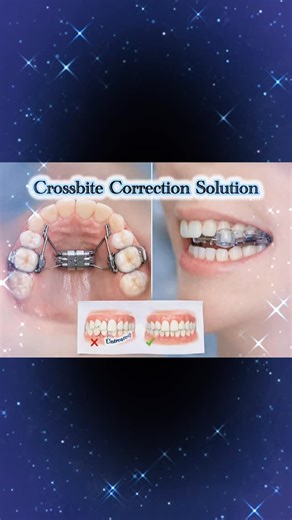 Dental Care | 🦷 Hidden bite problems like crossbite can affect both your smile and oral health. With the right orthodontic approach, alignment can be... | Instagram
