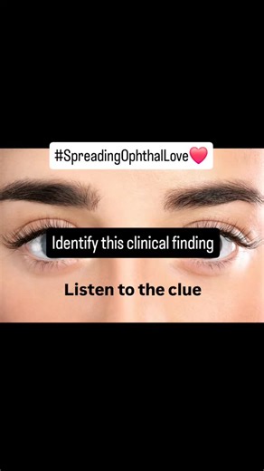 Dr Rajarathna Thangavel on Instagram: "A. Rubeosis iridis B. Heterochromia iridis C. Heterochromia iridum D. Brush field spots #ophthalimage👀 #ophthalmcq👀 #eyementor #rajarathna #spreadingophthallove❤️"