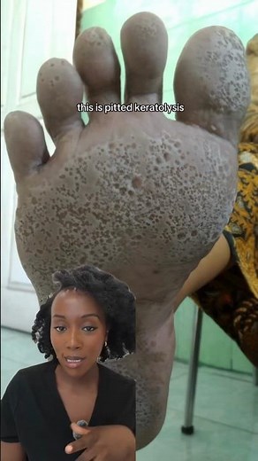 Why Your Feet Smell Bad (And Have Tiny Holes)!