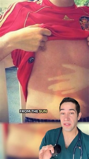 Always Wear Sunscreen! ☀️ Protect your skin, prevent burns, and stay healthy in the sun! #sunscreen #skincare #healthtips #sunprotection #dermatology #skincancerawareness #summerhealth #doctoradvice #skinhealth #foryou | Dr Myroo Figurra