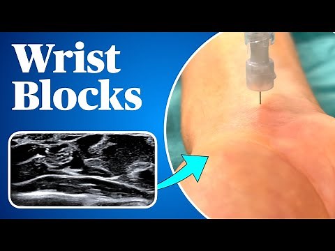Wrist Blocks (Landmark AND ultrasound guided approaches!)