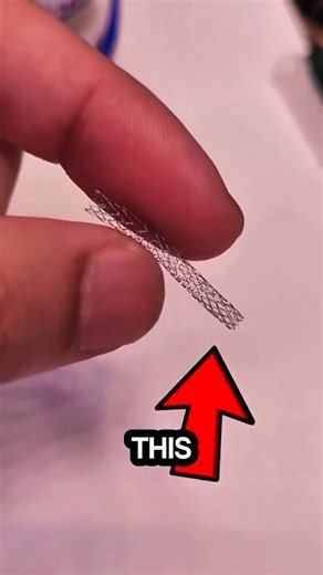 The Tiny Mesh That Saves Lives🤯