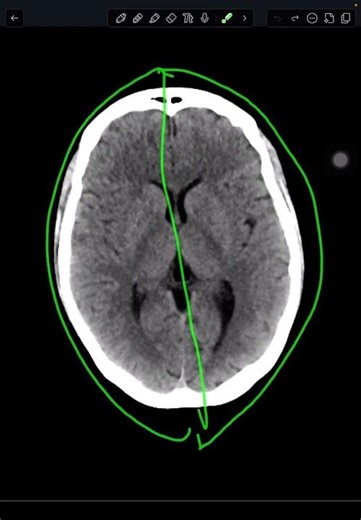 Normal CT Brain in 30 Seconds 🧠 | Easy Approach