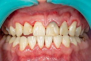 The Different Stages of Periodontal Disease - Sumner, WA