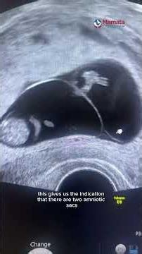 IVF Success Story: Triplet Pregnancy Seen on Early Ultrasound | Mamata Fertility Hospital: Hyderabad