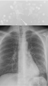 🫁 X-ray challenge! Can you find the hidden pneumonia? 🤔 This video reveals a crucial clue that could change the way you read chest X-rays! Follow for more medical insights! ➡️ #pneumonia #xray #medicaltips #doctor #healthcare #medicaleducation | Entice