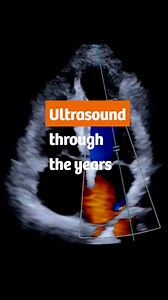 From sound waves to AI-powered smart devices — let’s take a look at ultrasound’s journey. | Siemens Healthineers