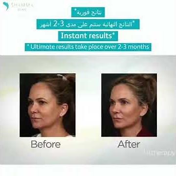 Ultherapy - The Non-invasive Lift