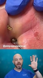 Nice and easy blackhead pop from behind the ear👂😇 (credit: @pimplepoppersus_ on TT) #blackhead #pop | Dr. Dustin Portela, Dermatologist