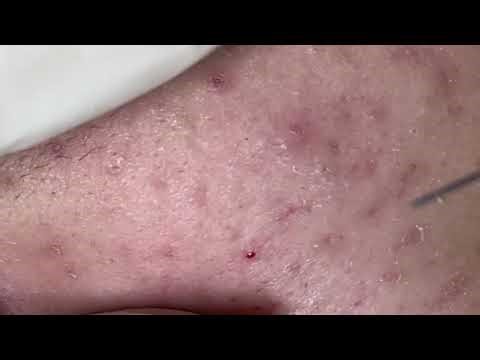 Extracting pimples with a needle avoids scarring